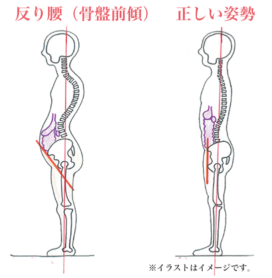 出っ尻 反り腰 の解消は 腸腰筋 を動かそう 札幌市西区 琴似整骨院 琴似駅より徒歩4分の鍼灸院